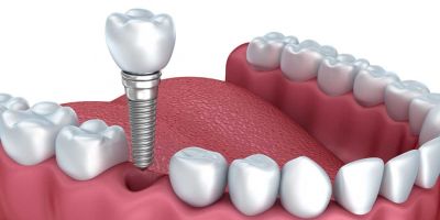 At Alabama Periodontics, we specialize in dental implant placement, cosmetic gum contouring, treatment of periodontal disease, receding gums, the diagnosis and treatment of oral pathologies, and preventative cleanings. We utilize the latest technology, including dynamic 3D navigation and laser-assisted surgeries to maximize the quickest healing times and best results for our patients.  https://www.alabamaperiodontics.com/