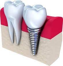 At Alabama Periodontics, we specialize in dental implant placement, cosmetic gum contouring, treatment of periodontal disease, receding gums, the diagnosis and treatment of oral pathologies, and preventative cleanings. We utilize the latest technology, including dynamic 3D navigation and laser-assisted surgeries to maximize the quickest healing times and best results for our patients. https://www.alabamaperiodontics.com/